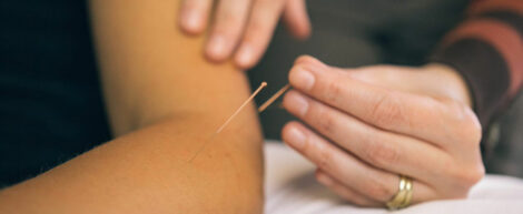 Acupuncture photo